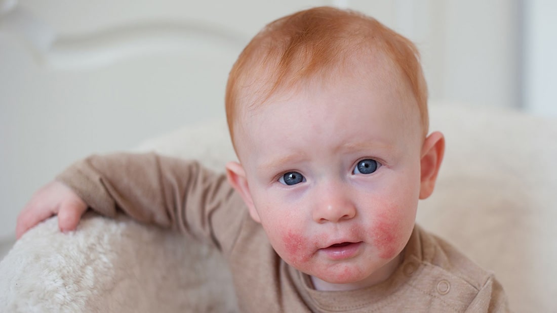 Il tocco lenitivo: come la biancheria da letto naturale può alleviare l'eczema del bambino